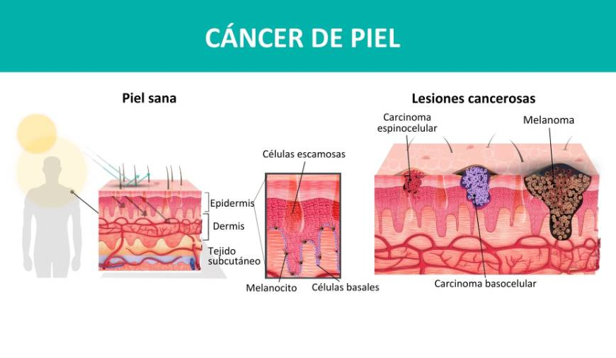 Cáncer de piel: Eva Gómez comparte su historia de melanoma